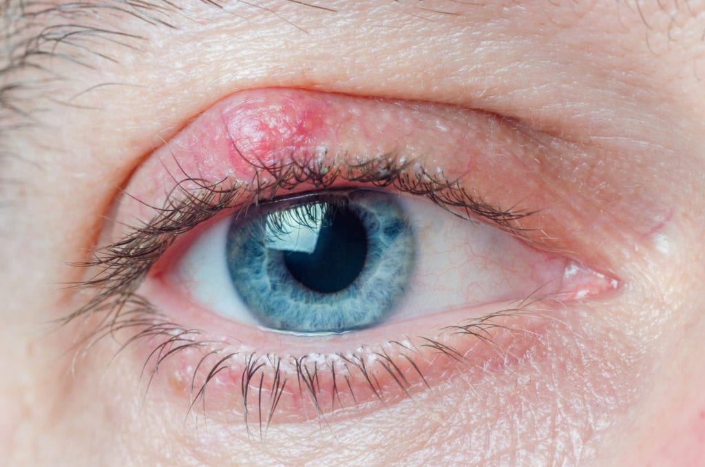 Chalazion on the eyelid of a man close-up.