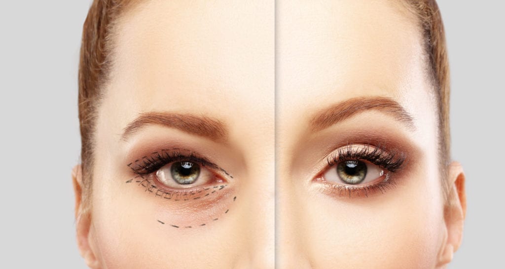 Before and after a lower eyelid blepharoplasty