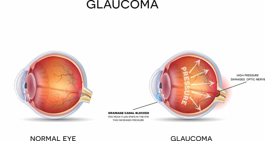 glaucoma vector id653408478