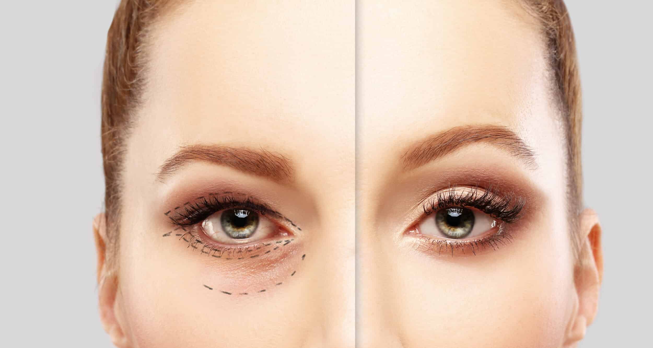 Lower Blepharoplasty.Upper blepharoplasty.Marking the face.Perforation lines on females face, plastic surgery concept.